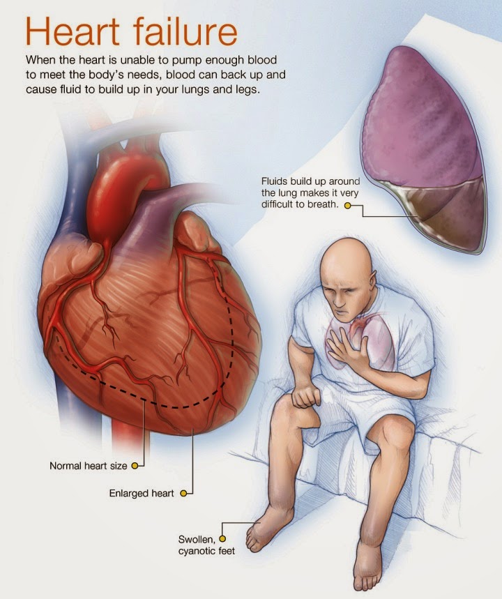 Heart Failure Management Dr Rahul Kaiche